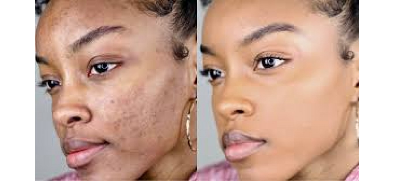 Clear up Acne Scars with these simple Ingredients Clear up Acne Scars with these simple Ingredients